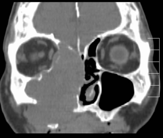 Squamous Cell Carcinoma Maxillary Sinus